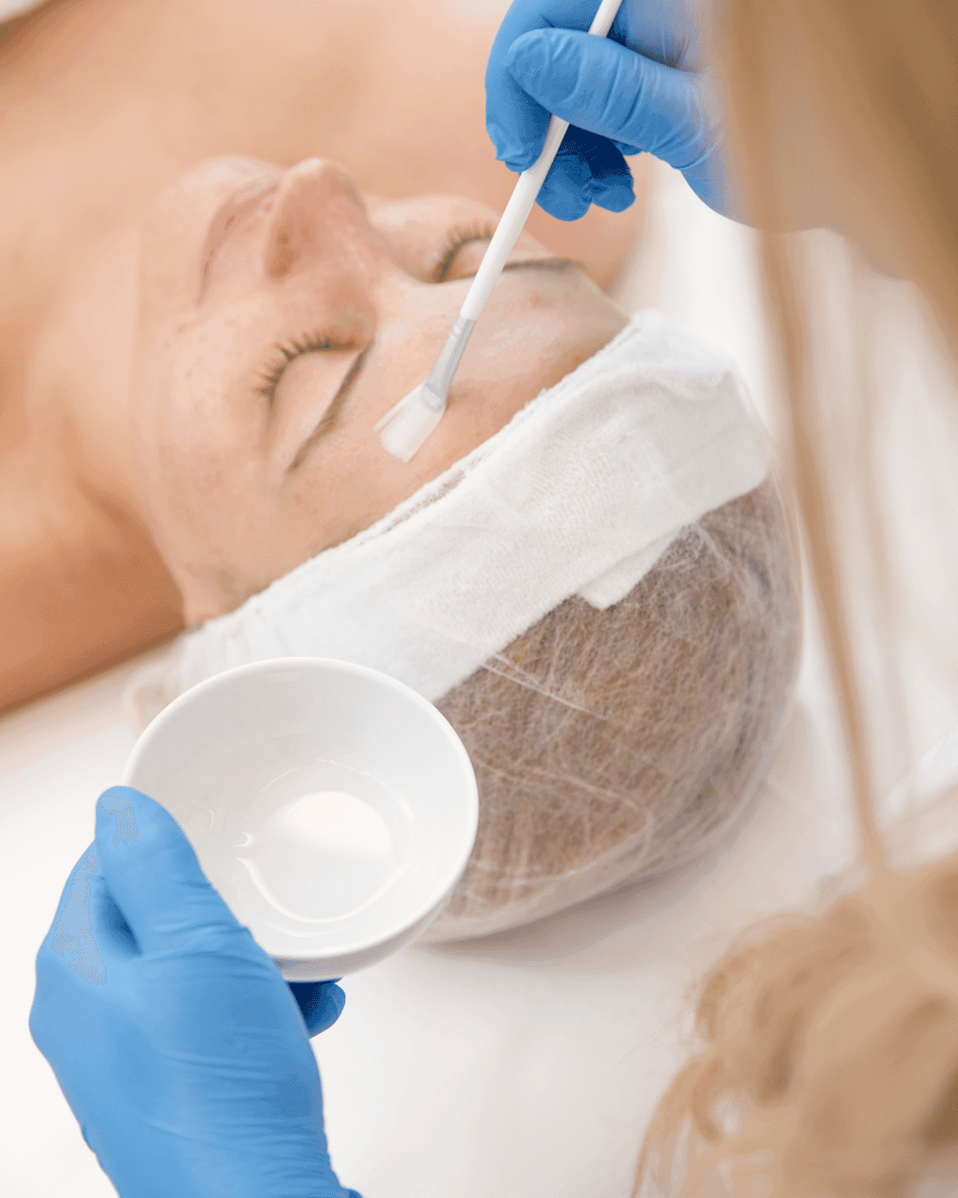 Chemical Peels