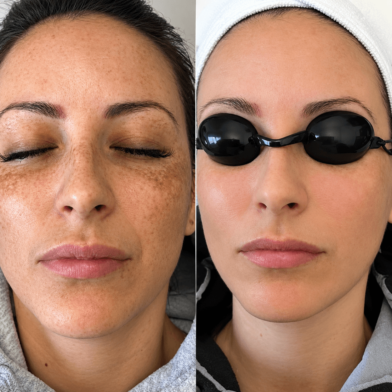 Pico Laser Treatment