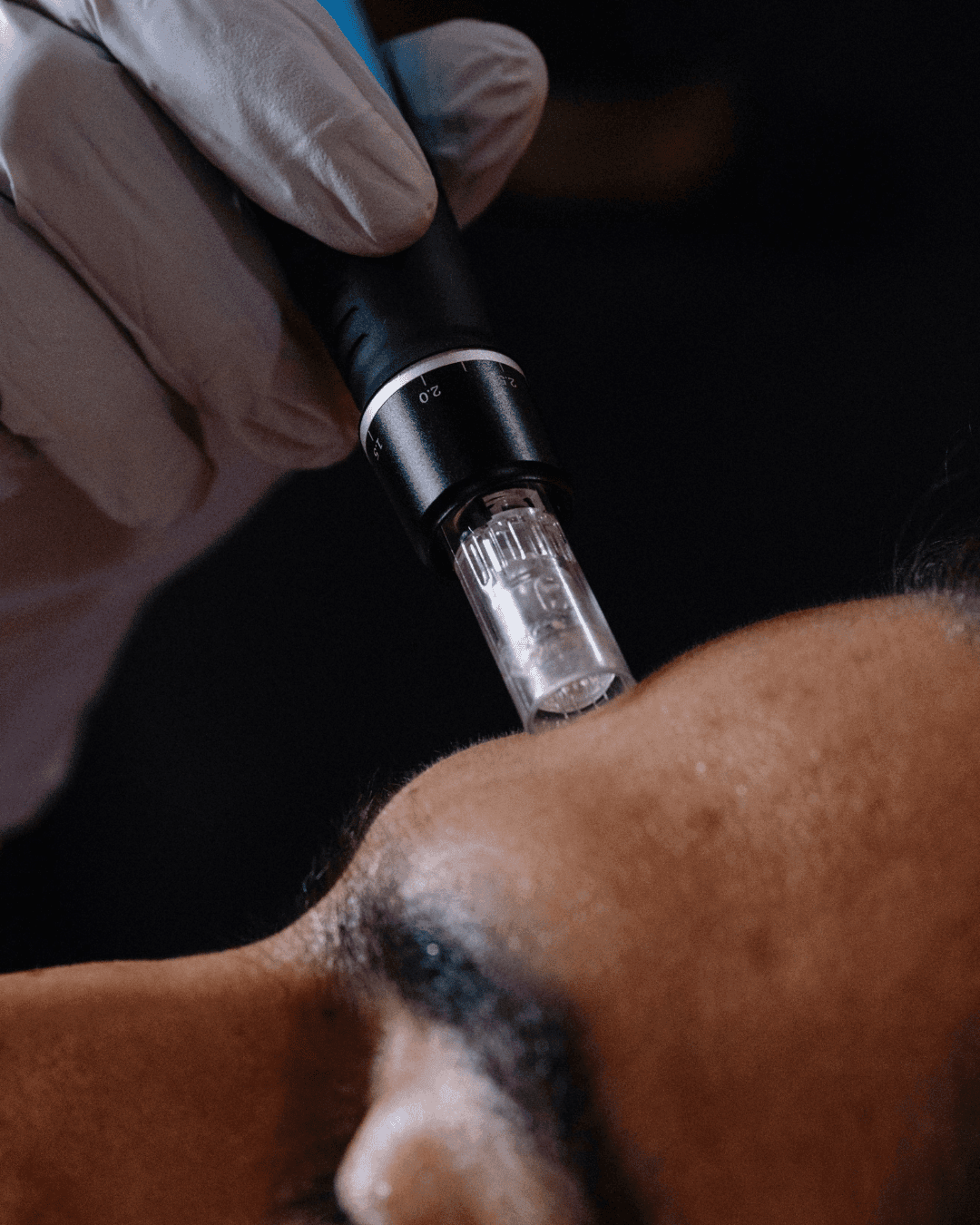 Dermal & Follicular Regeneration