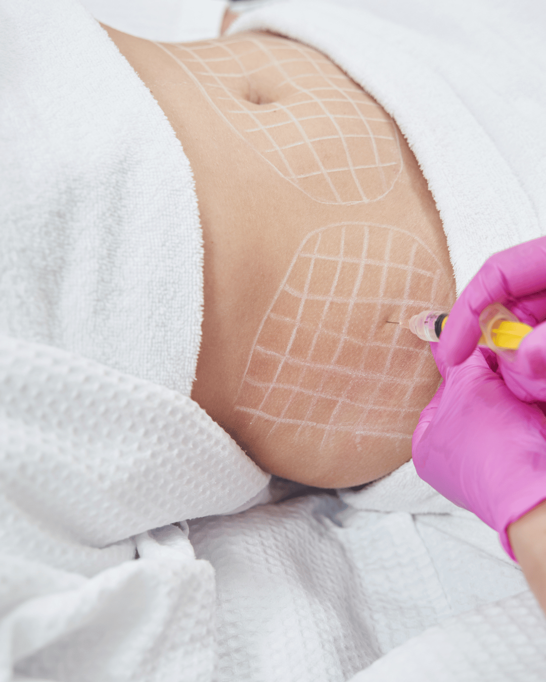 Fat Dissolving Injections